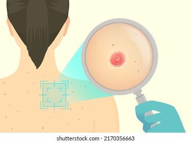 La mano del doctor usa vidrio de aumento para escanear y ampliar un carcinoma basocelular en la piel de la espalda de las mujeres. Ilustración sobre el diagnóstico de cáncer con dermoscopia. tumor, melanoma.