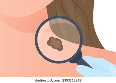 doctor checks mole under magnifier; melanoma skin cancer prevention- vector illustration
