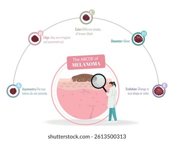 Doctor explaining the abcde of melanoma, showing asymmetry, border, color, diameter and evolution using a magnifying glass