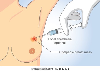 Doctor find breast cancer with a fine needle aspiration procedure. Illustration about Health check for woman.