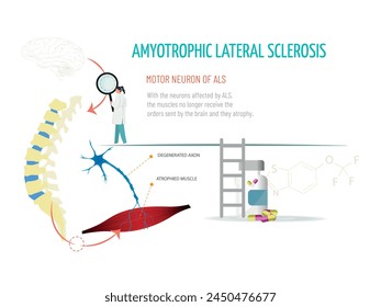 A doctor looks at a spinal column with a magnifying glass. She checks that the signal from the brain does not reach the muscle due to the disease. Amytrophic lateral sclerosis concept.