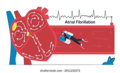 Doctor treats a heart disease that is atrial fibrillation. AF is common type of irregular heartbeat. Electrical signals in atrium cause atrium to beat quickly and erratically. Cardiology vector.