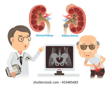 Doctors are advising the old kidney stones.
He with pain. Vector cartoon illustration