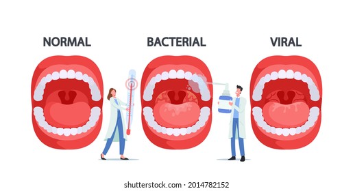 Caracteres médicos con termómetro y pulverización para garganta que presentan faringitis normal, bacteriana y viral o infección por bacterias Streptococcus tonsil. Ilustración de vectores de personas de caricatura