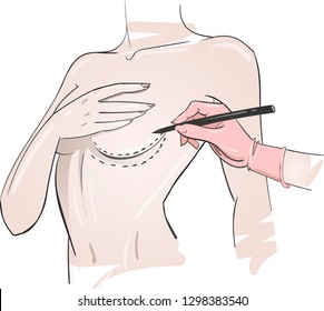 Doctor's hands wearing pink gloves drawing perforation lines on breast before breast augmentation operation. Plastic surgery concept. Fashion woman sketch. Hand drawn vector illustration.