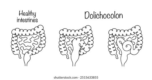 Dolicocolon. Afección patológica en la que se presenta elongación de una o más partes del intestino Grande. Intestinos sanos e intestinos con trastornos anatómicos. Ilustración vectorial.