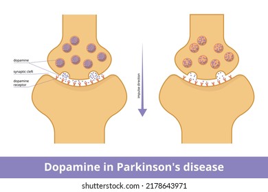 Dopamine In Parkinson's Disease. Visualization Of Dopamine Production Decrease Due To Neurodegeneration That Is Closely Bound To Parkinson's Disease.