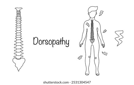 Dorsopatía. Síndrome de dolor en la espalda, que se irradia a las extremidades inferiores y superiores. Dibujo de una línea de un hombre con problemas en la columna vertebral que se irradian a diferentes partes del cuerpo. Vector.