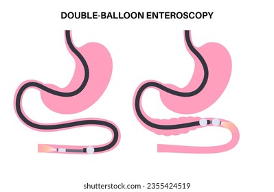 Double balloon enteroscopy minimally invasive procedure. Visualization of the small intestine. Biopsy, polyp removal, bleeding therapy, stent placement in gastrointestinal tract .vector illustration.