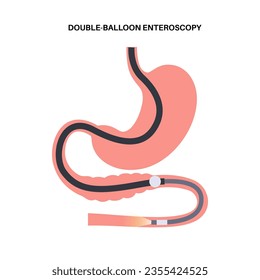 Double balloon enteroscopy minimally invasive procedure. Visualization of the small intestine. Biopsy, polyp removal, bleeding therapy, stent placement in gastrointestinal tract .vector illustration.