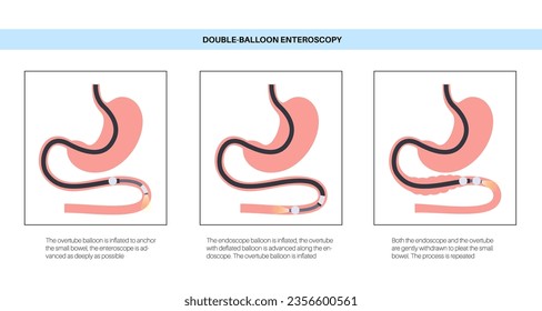 Double balloon enteroscopy minimally invasive procedure. Visualization of the small intestine. Biopsy, polyp removal, bleeding therapy, stent placement in gastrointestinal tract .vector illustration.