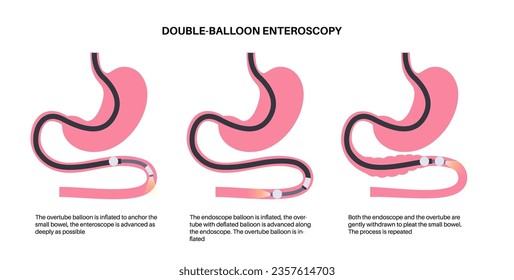 Double balloon enteroscopy minimally invasive procedure. Visualization of the small intestine. Biopsy, polyp removal, bleeding therapy, stent placement in gastrointestinal tract .vector illustration.