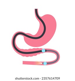 Double balloon enteroscopy minimally invasive procedure. Visualization of the small intestine. Biopsy, polyp removal, bleeding therapy, stent placement in gastrointestinal tract .vector illustration.