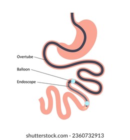 Double balloon enteroscopy minimally invasive procedure. Visualization of the small intestine. Biopsy, polyp removal, bleeding therapy, stent placement in gastrointestinal tract .vector illustration.