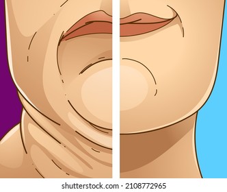 Double chin. Before, After. Healthcare illustration. Vector illustration.