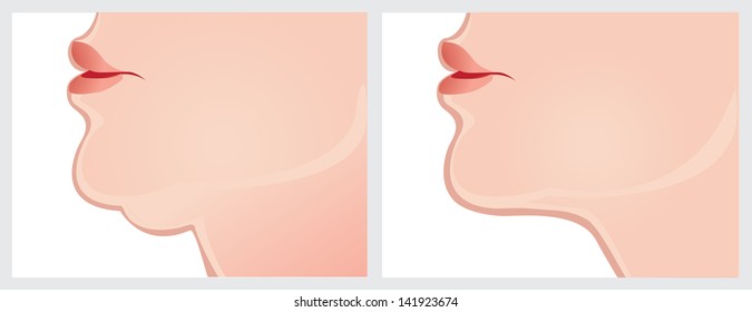 double chin, before and after. Vector image on a white background. Scroll down to see more of my designs linked below.