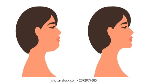 Doble barbilla, antes y después. Una mujer de perfil con una segunda barbilla que gotea y una cara con tonificación. Ilustración vectorial, dibujo plano de diseño mínimo aislado sobre fondo blanco, eps 10.