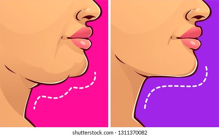 Double chin, before-after. Woman face. Vector illustration. 