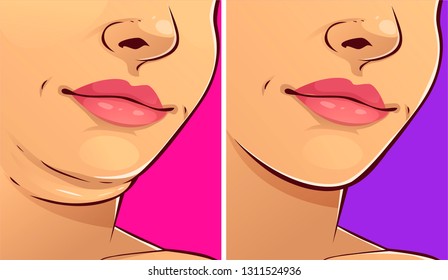 Double chin, before-after. Woman face. Vector illustration. 