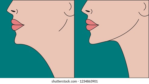 Double chin correction, plastic surgery, chin before and after, facial contour. Vector illustration