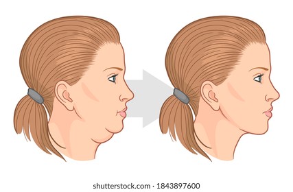 Double chin fat loss before and after vector illustration.
