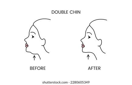 Double chin, laser cosmetology before procedure and after applying treatment line icon in vector. Illustration of a woman with smooth clean skin and problematic skin.