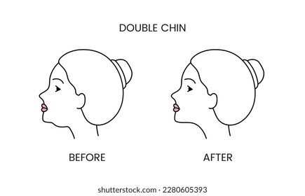 Double chin, laser cosmetology before procedure and after applying treatment line icon in vector. Illustration of a woman with smooth clean skin and problematic skin.