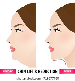 Double Chin Lift And Reduction Before And After Vector Illustration