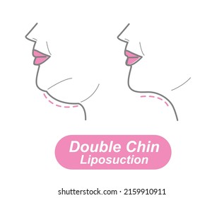 Double Chin Liposuction , Double Chin liposuction vector. EPS