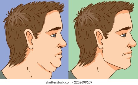 Double chin. The man with the age problems on her face. Before, after. Face correction. Healthcare illustration. Vector illustration. 