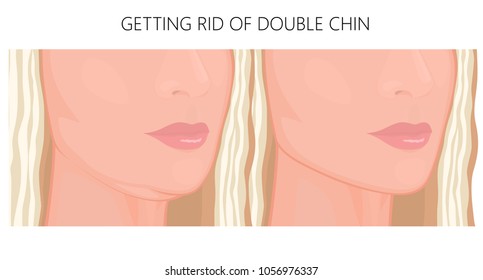 Double chin on face in half turn, before and after treatment. Close up view. For packaging of medicinal, pharmacy products, cream, lotion, cosmetic procedures advertising. EPS 10.