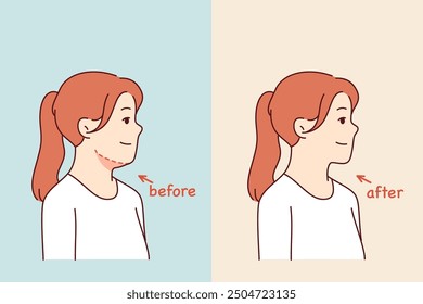 Double chin removal surgery for young girl posing before and after procedure with cosmetologist. Losing excess weight caused woman to get rid of double chin and increase attractiveness.