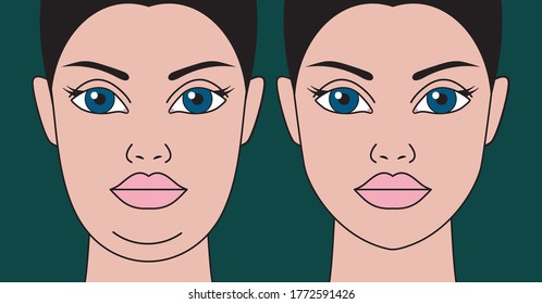 Double chin, restoration of facial contours with aid liposuction, weight loss and exercise. Rejuvenation of female face.