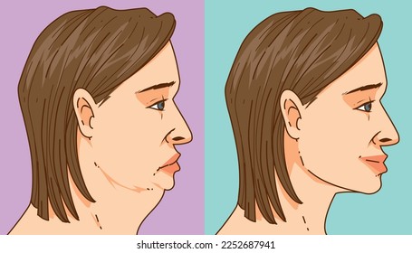 Double chin. The woman with the age problems on her face. Before, after. Face correction. Healthcare illustration. Vector illustration. 