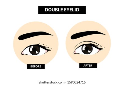 Double Eyelid ,before And After Vector Illustration