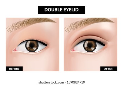 Double eyelid ,before and after vector illustration