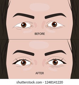 Double eyelid surgery before and after vector illustration. EPS10