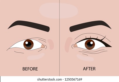 double eyelid surgery before and after vector illustration. EPS10