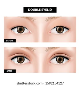 Double Eyelid Surgery Before And After Vector Illustration