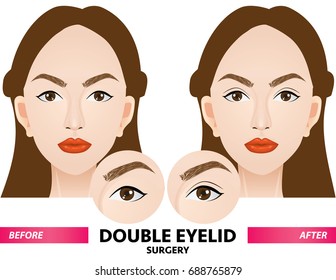 double eyelid surgery before and after vector illustration