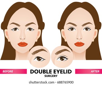 Double Eyelid Surgery Before And After Vector Illustration