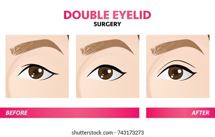 Double eyelid surgery before and after vector illustration