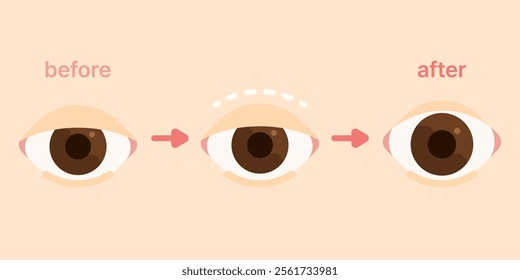 double eyelid surgery blepharoplasty plastic surgery