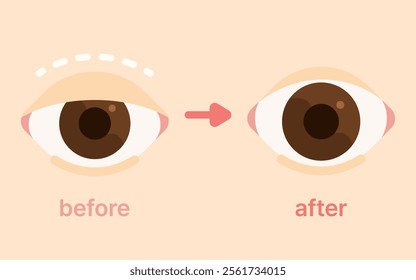 double eyelid surgery blepharoplasty plastic surgery