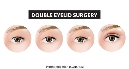 Double eyelid surgery how to step vector illustration
