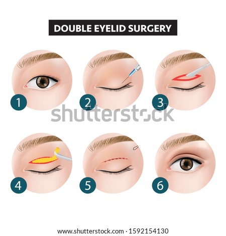 Similar – Image, Stock Photo Double sutured scar of abscess surgery on a back