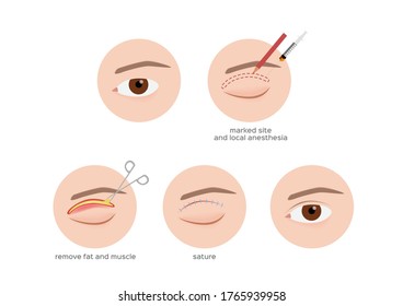 double eyelid surgery infographic step vector / cosmetic surgery on white background