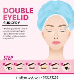 Double Eyelid Surgery Steps Vector Illustration