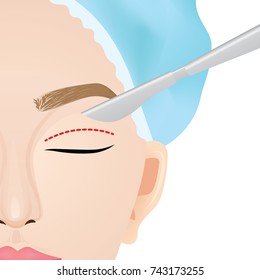 Double Eyelid Surgery Vector Illustration