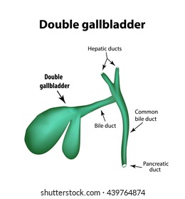 Double gall bladder. Pathology of the gallbladder. Cholecystitis. The structure of the gallbladder. Infographics. Vector illustration on isolated background.